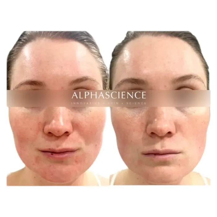 Сыворотка обновляющая с фитиновой кислотой Alphascience Phytic [TC] Serum